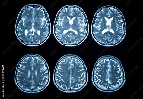 Brain stroke x-ray;MRI of the blood vessels in the brain and cerebrovascular disease or ...