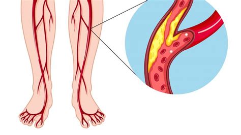 Peripheral Artery Disease Nhlbi Nih