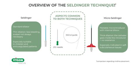 Seldinger technique: when to use the classical or modified method - Campus Vygon