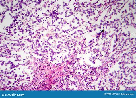 Testicular Seminoma Light Micrograph Stock Photo Image Of Closeup