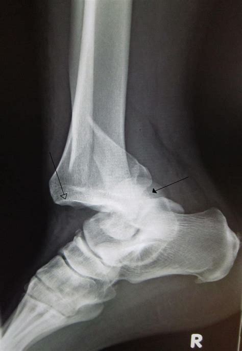 Ankle Dislocation Wikem