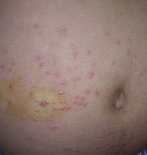 Figure 1 From Molluscum Like Papules As A Presentation Of Early