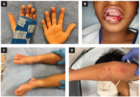 Rash characteristics of paediatric patients with COVID-19 in Singapore ...