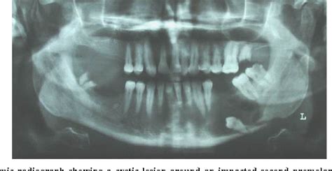 Pathological Fracture Mandible