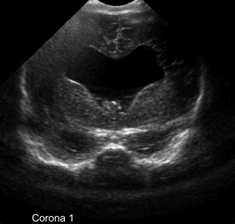 Septo Optic Dysplasia Ultrasound