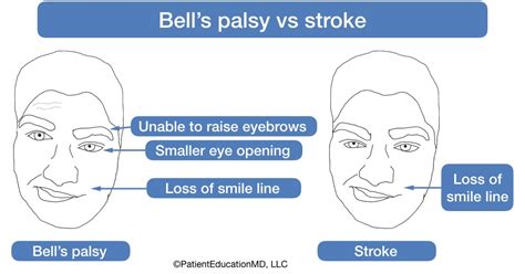 Bells Palsy Vs Stroke Patienteducationmd