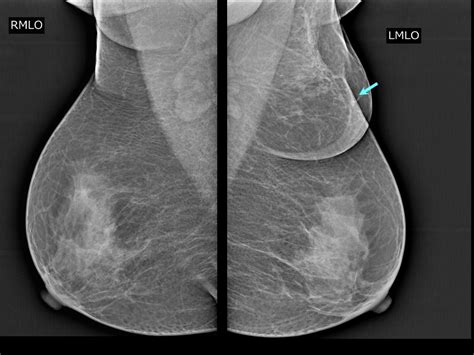 Normal Breast Cells