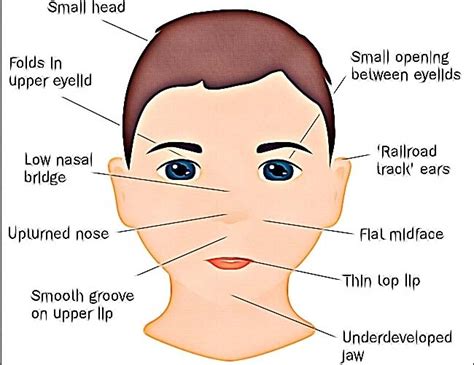 Fetal Alcohol Syndrome In Adults Signs And Symptoms