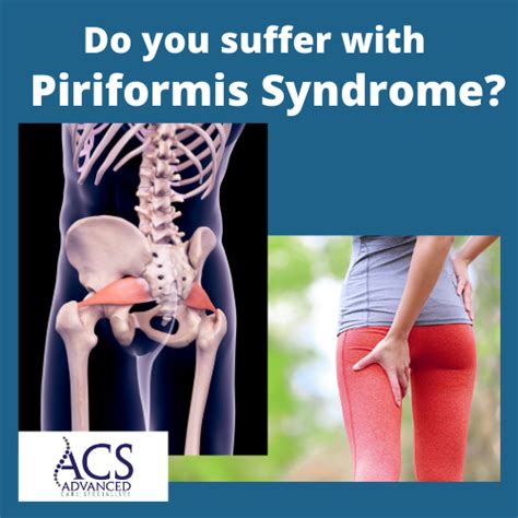 Sciatica And Piriformis Syndrome Simple And Effective Exercises For