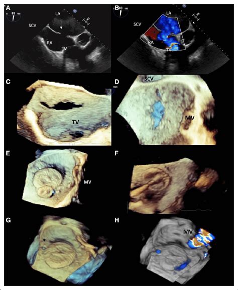 Figure Echocardiographic Assessment Of The Defect A Two Dimensional