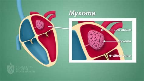 Myxomas St Vincent S Heart Health