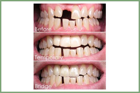 Temporary Dental Bridge - Best Image Viajeperu.org