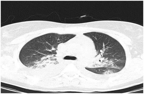 Spiral Chest CT Scan Revealed Bilateral Pleural Effusion Significant