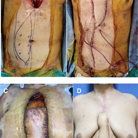 Pedicled Vertical Rectus Abdominis Myocutaneous Vram Flap