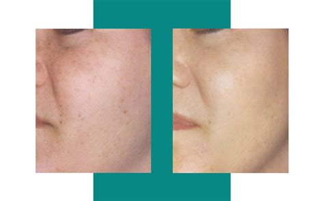 Laser Skin Treatments Lasting Skin Solutions