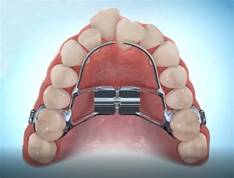 The Complete Guide To Palate Expanders And Braces