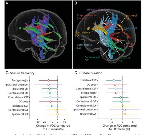 Figure From Bilateral Structural Network Abnormalities In Epilepsy