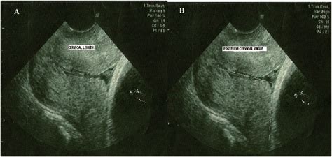 Transvaginal ultrasound images of the cervix showing cervical length ...