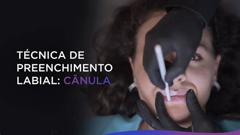 Preenchimento Labial Técnica Com Cânula Youtube