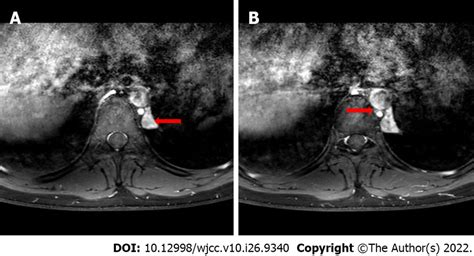 Chest Magnetic Resonance Imaging A The Tumor Shows Heterogeneous