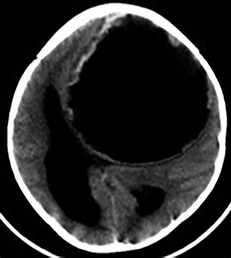 Axial Ct Scan Demonstrating A Large Hydatid Cyst In The Left Frontal