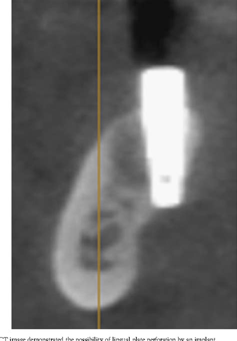 Figure 3 From Cross Sectional Analysis Of The Mandibular Lingual