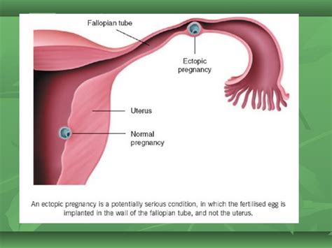 Ectopic pregnancy for undergraduate