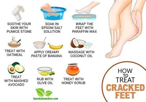 How to Treat Cracked Feet | Speedy Remedies