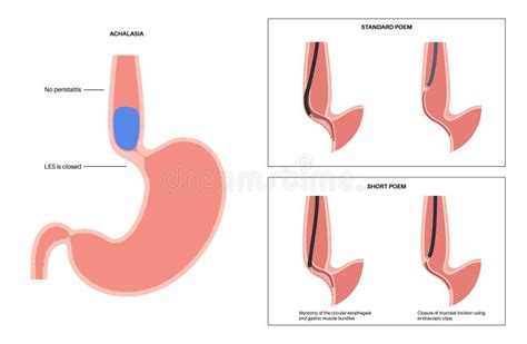 POEM medical poster stock illustration. Illustration of minimally - 290867049