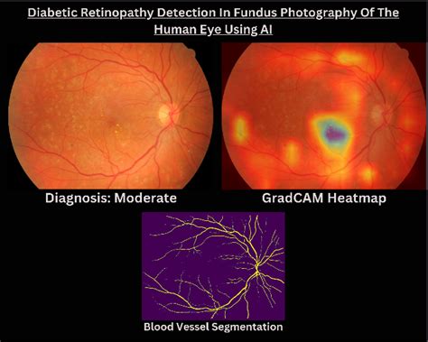 GitHub Rishiswethan Diabetic Retinopathy Detection Retinal Vessel