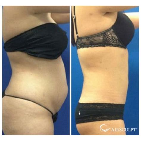 Pin On Airsculpt® Before And After Elite Body Sculpture