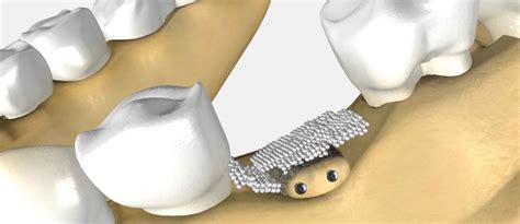 Bone Grafting American River Dental Rancho Cordova Dentist