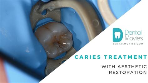 Caries Treatment With Aesthetic Restoration Youtube