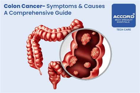 Colon Cancer Symptoms And Causes A Comprehensive Guide Accord