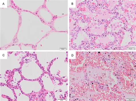 Histopathological Changes In H E Stained Lung Tissues Of Severe