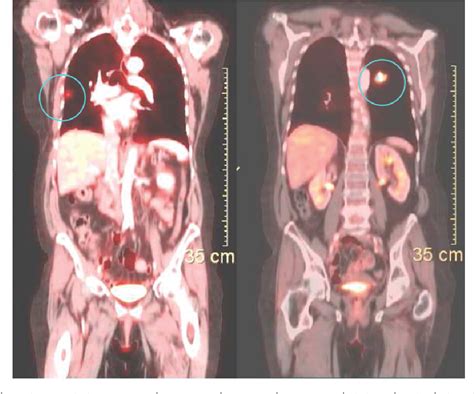 Figure From Triple Synchronous Primary Lung Cancer Semantic Scholar