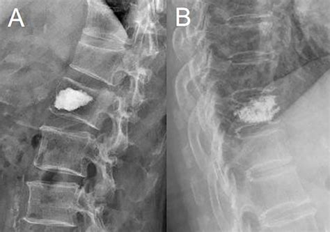 Frontiers Risk Factors Of New Vertebral Compression Fracture After