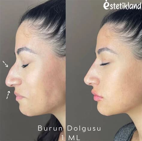 Nose Filler Non Surgical Nose Job Estetikland