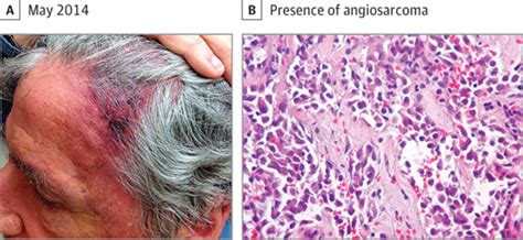 Growth Attenuation Of Cutaneous Angiosarcoma With Beta Blockade