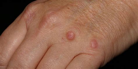 Granuloma - Definition of Granuloma