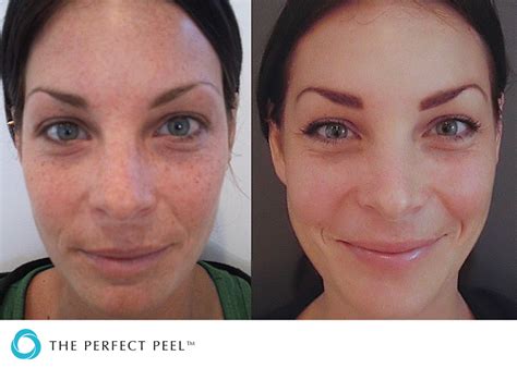 Chemical Peel Near Me Omaha Cosmetic Center