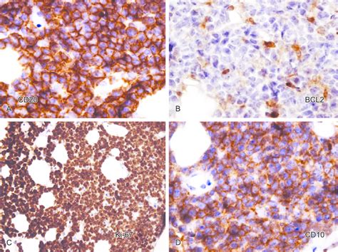 Photomicrography Immunohistochemistry Burkitt Lymphoma Cells Download Scientific Diagram