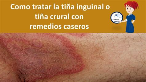 Como Tratar La Tiña Inguinal O Tiña Crural Con Remedios Caseros Tiña