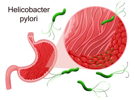 Helicobacter Pylori In Stomach Epithelial Cells Under Magnificat Ddg