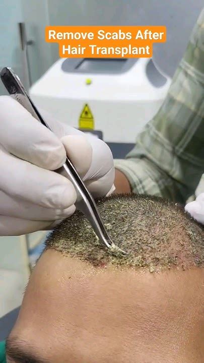 Remove Scabs After Hair Transplant Hairtransplant Shortsvideo Youtube