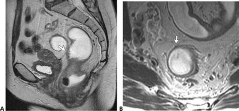 Peritoneal Reflection Of The Line