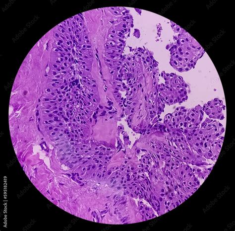 Nodular Cystic Hidradenoma Clear Cell Hidradenoma Nodular Hidradenoma