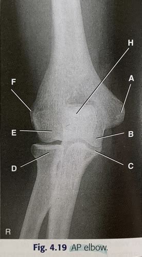 AP Lateral Elbow Anatomy Review Flashcards Quizlet