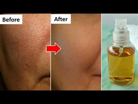 How To Get Rid Of Large Open Pores In Week Naturally Close Large