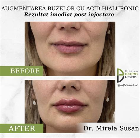 Injectari Cu Acid Hialuronic Dermavision Cluj